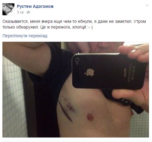 Російський блогер Адагамов показав свої "травми" після нападу у Києві - фото 1