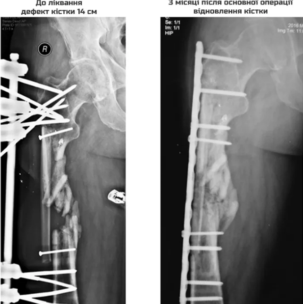 Українські лікарі виростили нову кістку ноги пораненому добровольцю (ФОТО, ВІДЕО) - фото 1