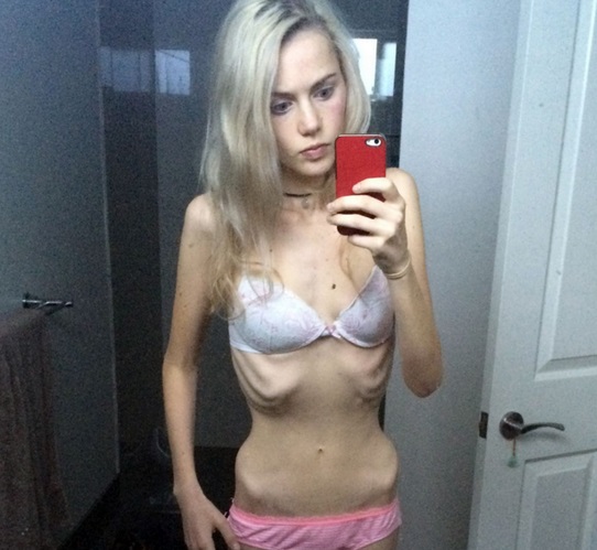 17-річна австралійка, яка схудла на 40 кілограмів, ледве вижила  - фото 2