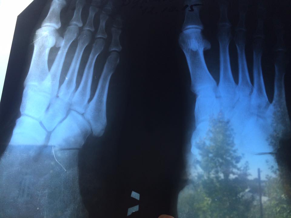 Фронтовик Булатов зламав ногу, коли чистив зуби - фото 1