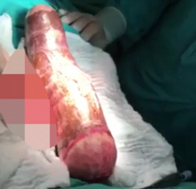 55-річний чоловік зазнав реконструкції кишечника через дерев'яний 