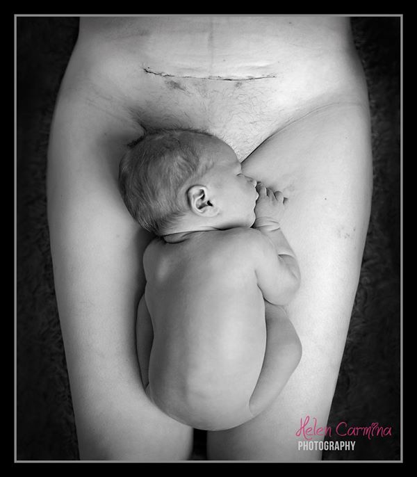 Фото жінки після кесаревого розтину сколихнуло Інтернет - фото 1