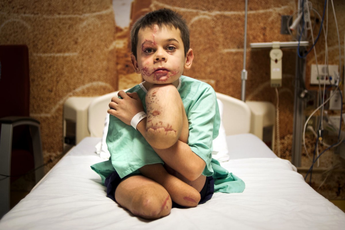 Фото хлопчика, який підірвався на Донбасі, перемогло у міжнародному конкурсі - фото 1