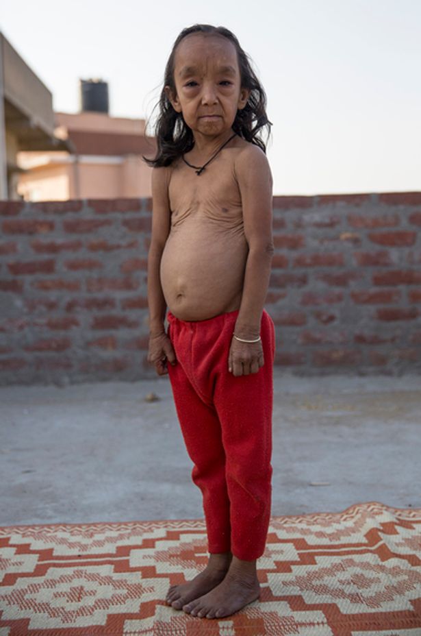 Як Бенджамін Баттон: в Індії двоє дітей через хворобу виглядають як старці  - фото 1