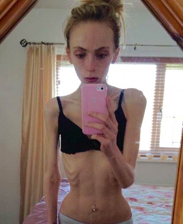 19-річна британка жахнула Інтернет висохлим від голодування тілом - фото 1