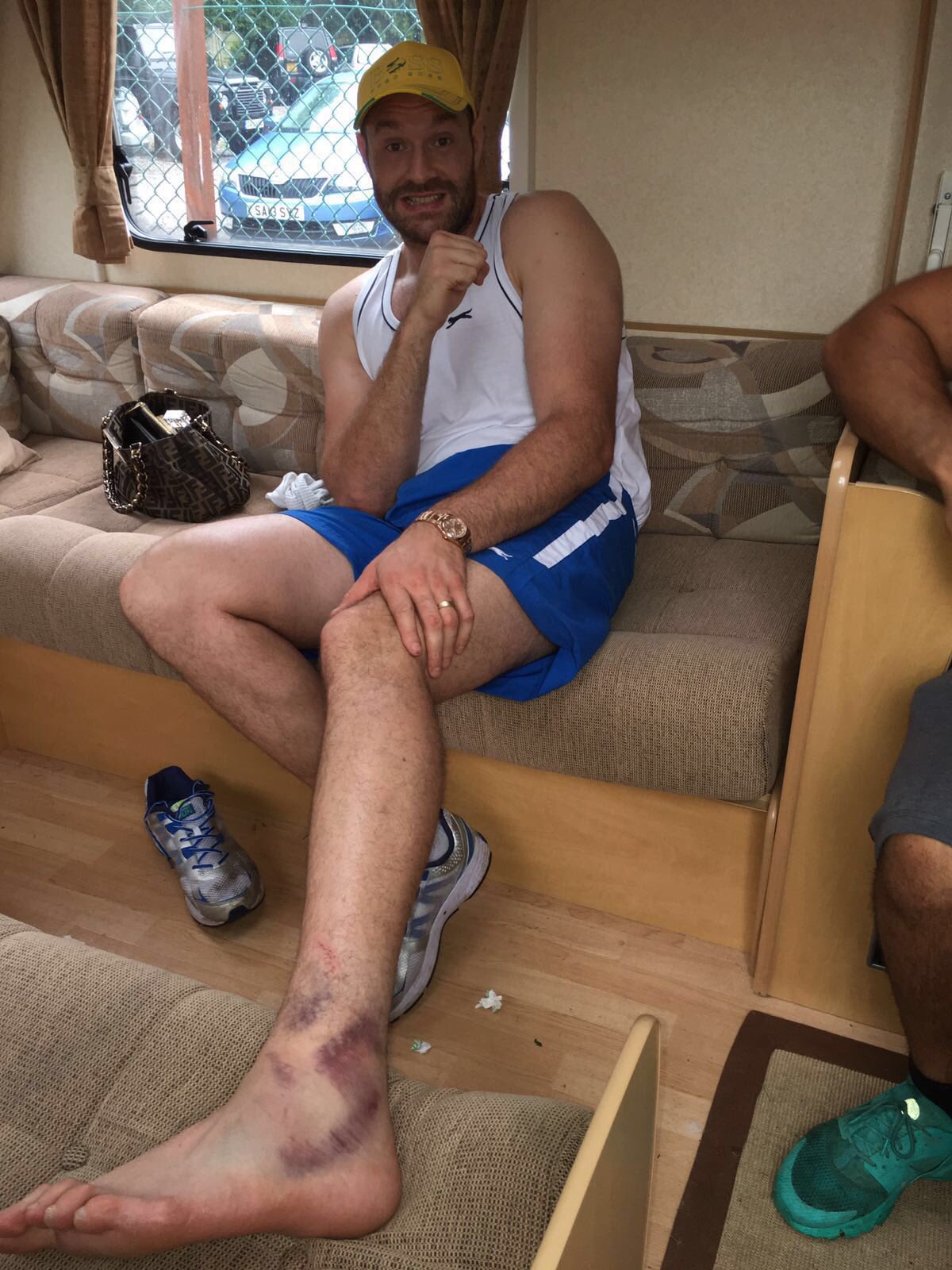 Бій Кличко-Ф'юрі перенесено через травму британця - фото 1