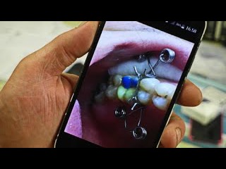 Як стоматологи в зоні АТО видирають зуби російській пропаганді - фото 7