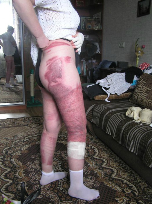 У Запоріжжі лікується жінка-доброволець, яка обгоріла в зоні АТО (ФОТО) - фото 1
