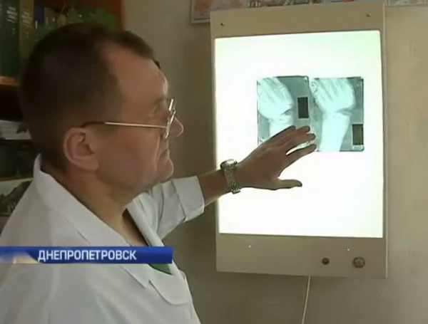 В дніпропетровській лікарні врятували кісті 120 пораненим бійцям - фото 1