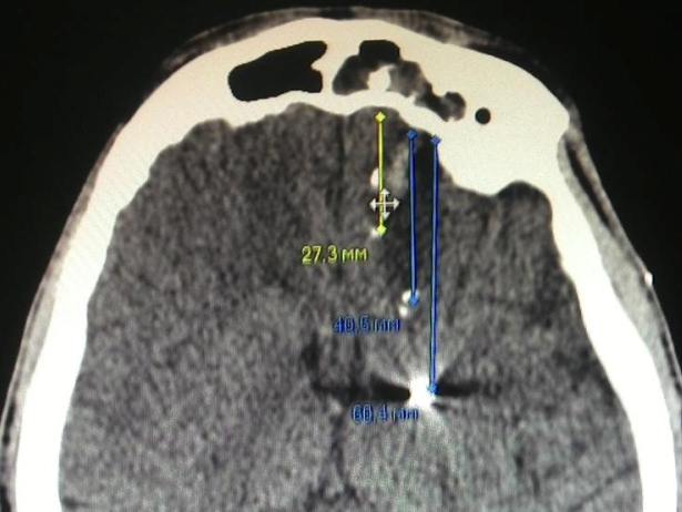 Дніпропетровські нейрохірурги врятували бійця з осколком в голові (ФОТО) - фото 2