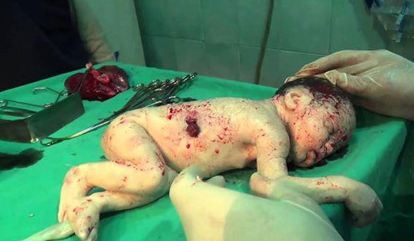 У Сирії дівчинка народилася зі шрапнеллю в голові - фото 1