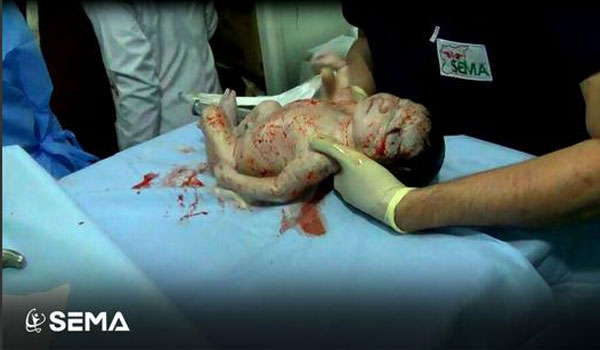 У Сирії дівчинка народилася зі шрапнеллю в голові - фото 2