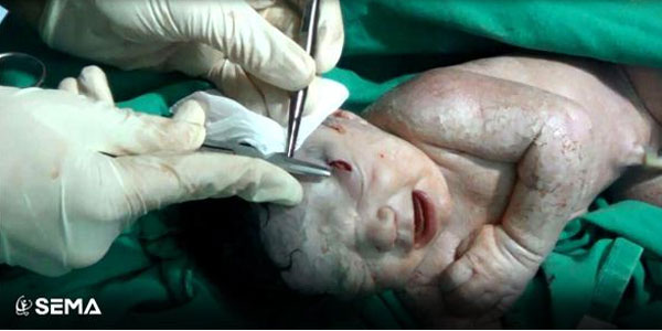 У Сирії дівчинка народилася зі шрапнеллю в голові - фото 3