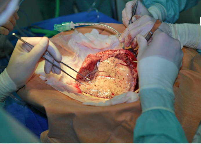 В Україні вперше трансплантували легені - фото 3