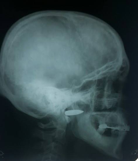 Дніпропетровські лікарі витягли кулю з черепа бійця АТО - фото 2