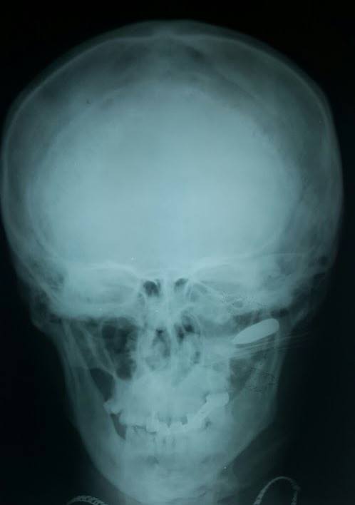 Дніпропетровські лікарі витягли кулю з черепа бійця АТО - фото 1
