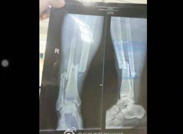 З'явилися фотографії рентгену переламаної ноги екс-нападника 