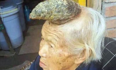 У Китаї у жінки на лобі виріс величезний ріг  - фото 1