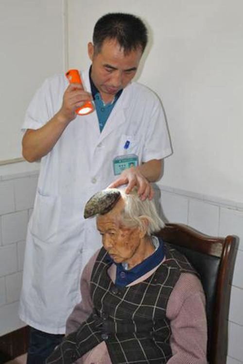 У Китаї у жінки на лобі виріс величезний ріг  - фото 2