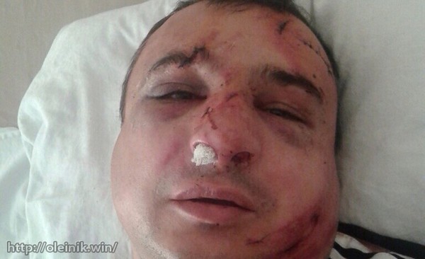У мережі з'явилися фото побитого луганського сепаратиста Клінчаєва - фото 1