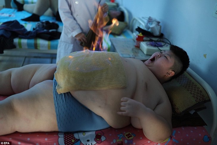 У Китаї дитину, яка важить 150 кілограмів, лікують вогнем - фото 2