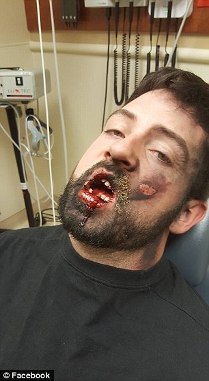 У США електронна сигарета під час вибуху вибила чоловікові зуби (ФОТО 18+) - фото 4