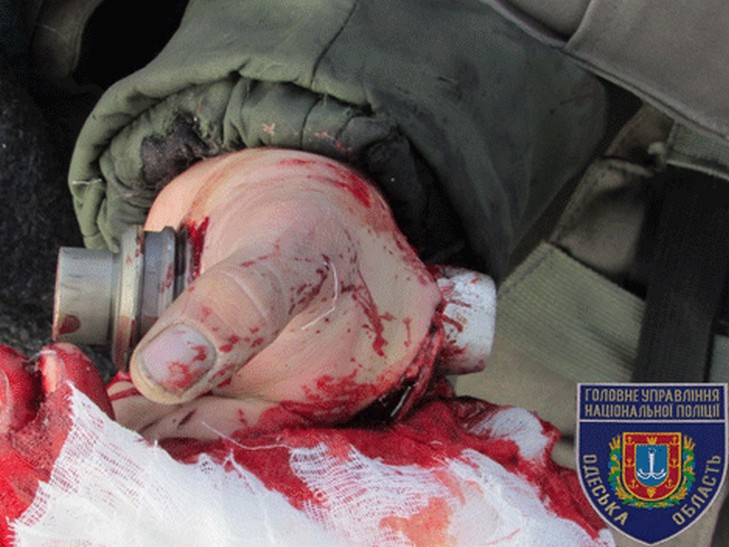 В Одесі поліцейські вибухотехніки врятували життя військовослужбовцю (ФОТО 18+) - фото 2