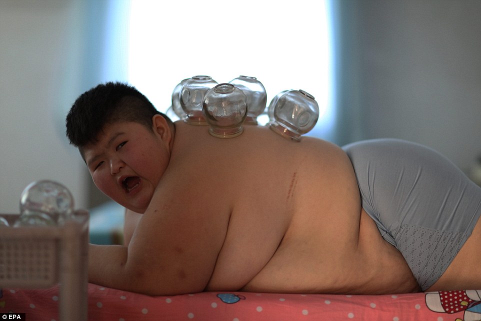 У Китаї підпалили 11-річного хлопчика, який важить 145 кг - фото 1