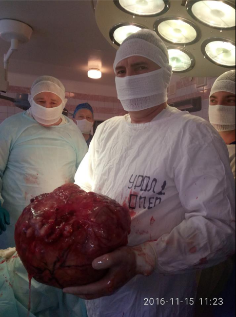 У Дніпрі лікарі після операції показали величезну пухлину нирки - фото 1
