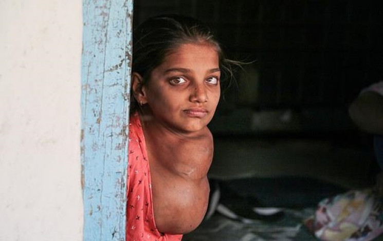 У 12-летней девочки из Индии выросла "вт…