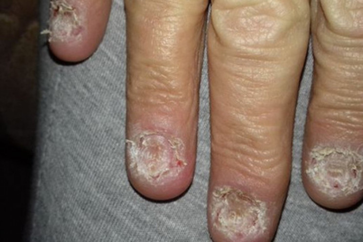 Загадочная болезнь разъела женщине ногти…